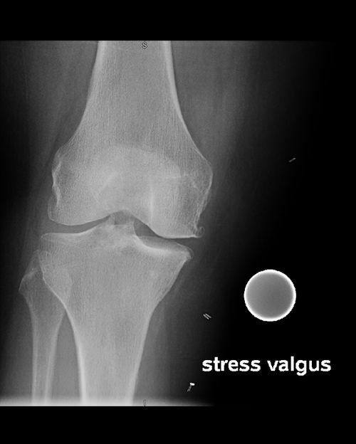 Arthrose médiale du genou