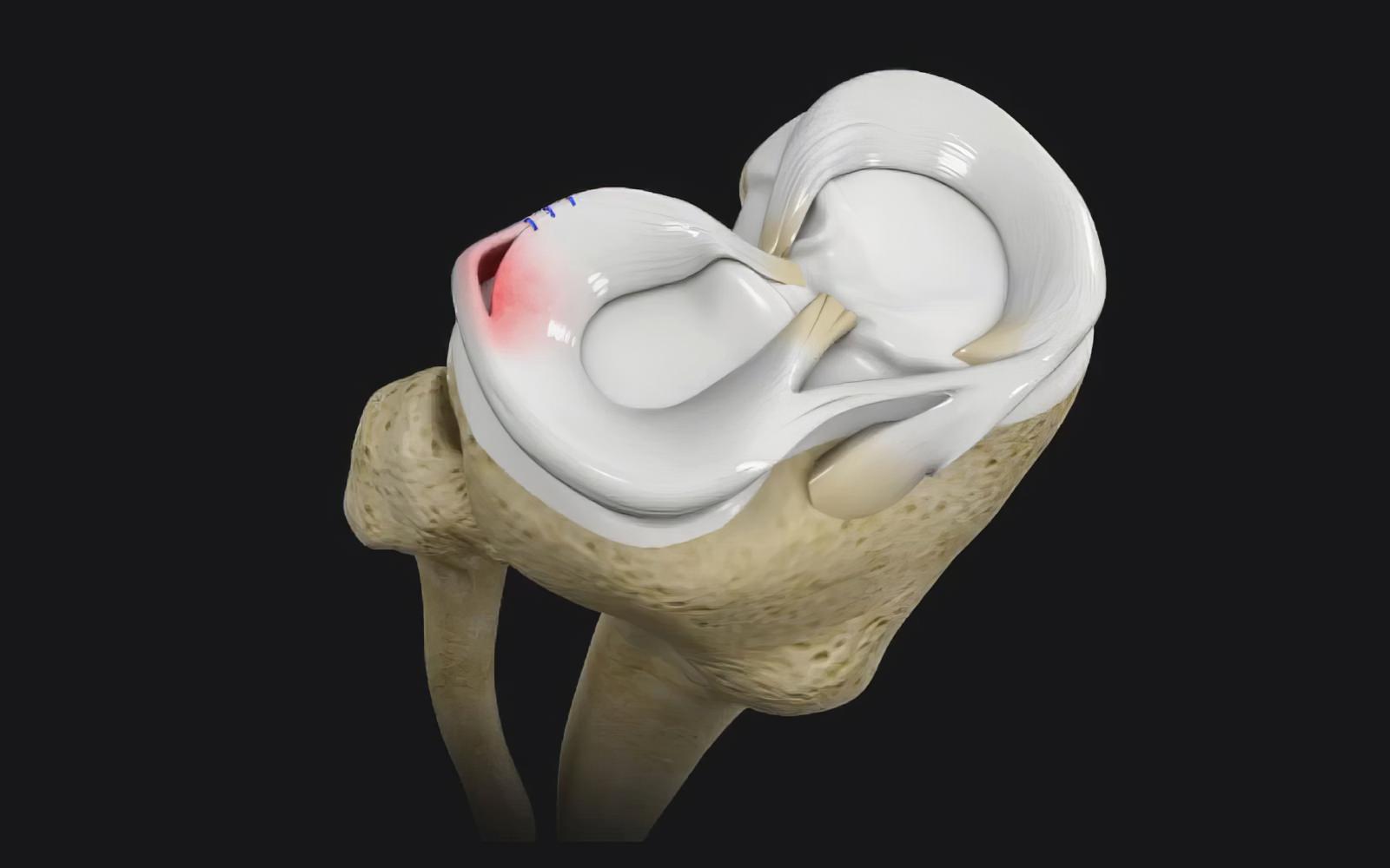 Ménisectomie ou sutures méniscales par arthroscopie | Dr Dani Massie ...